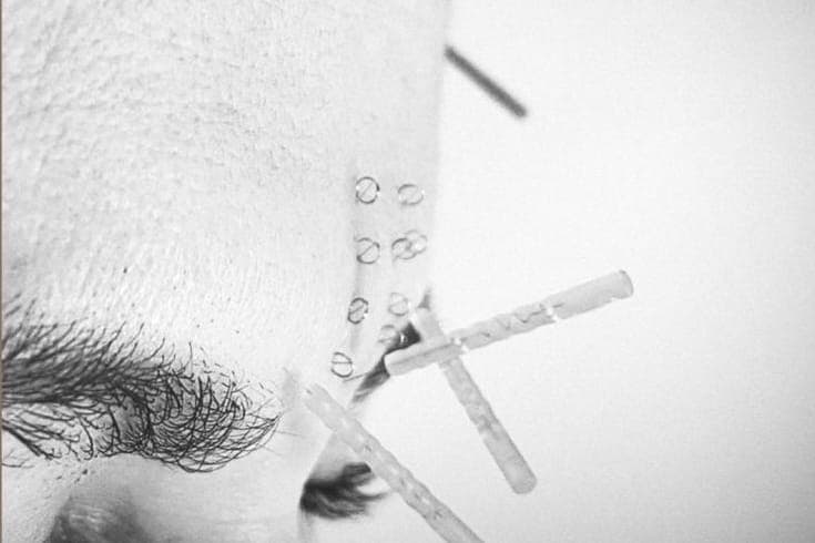 A close-up black-and-white photograph of fine needles placed beside the eye