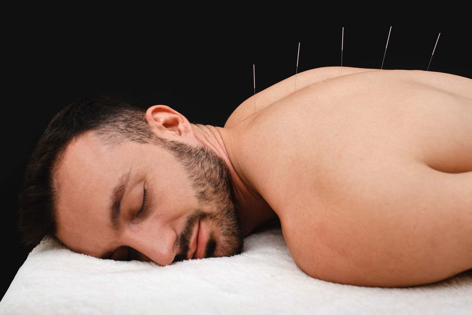 A patient lying face down with acupuncture needles along the back