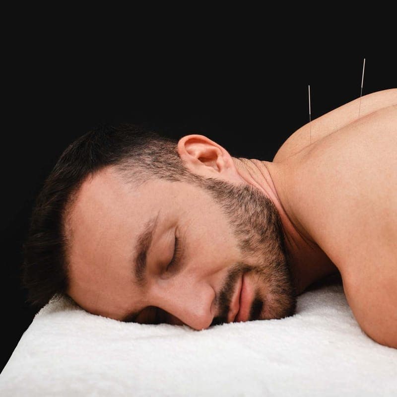 A patient lying face down on a treatment table with fine acupuncture needles placed along the upper back.