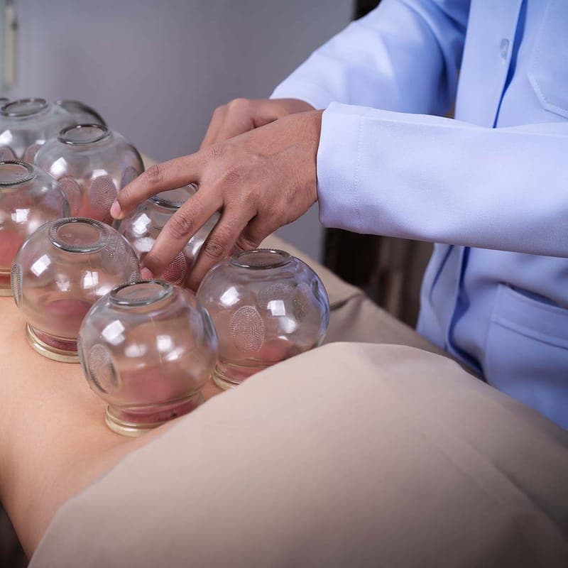 A practitioner placing rows of glass cupping jars along a patient's back.