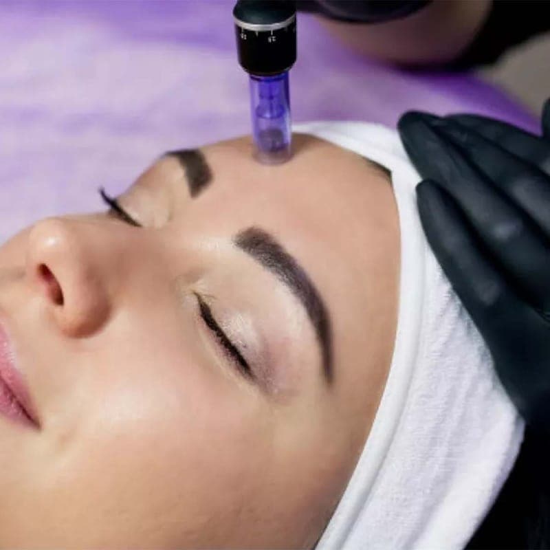 A microneedling pen drawn across a patient's forehead during a facial treatment.