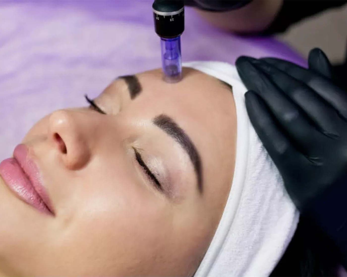 A microneedling pen drawn across a patient's forehead during a facial treatment.